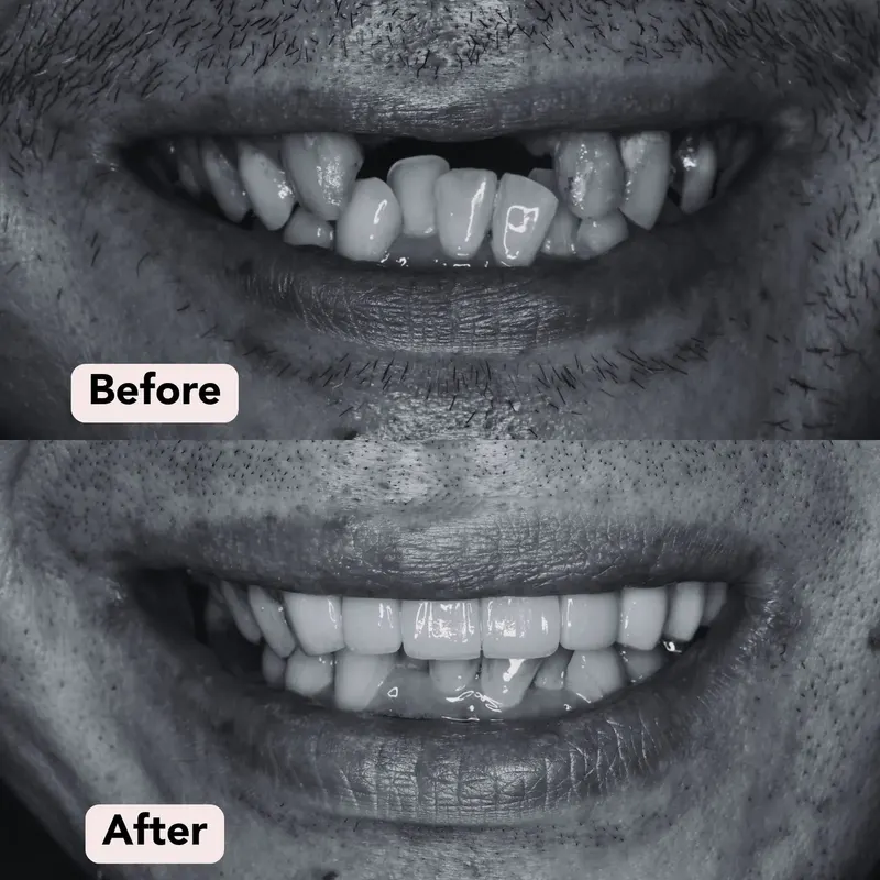 B w dental bridge before after
