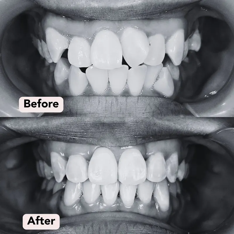 Bw braces dr s before after