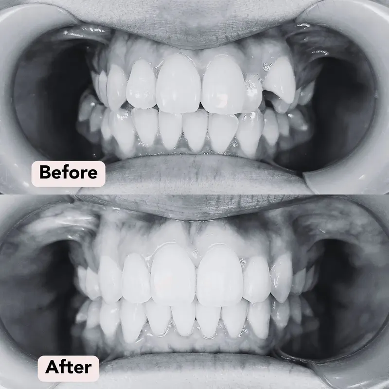 Bw braces dr s before after