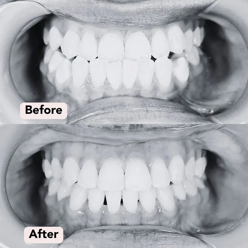 Bw braces dr s before after