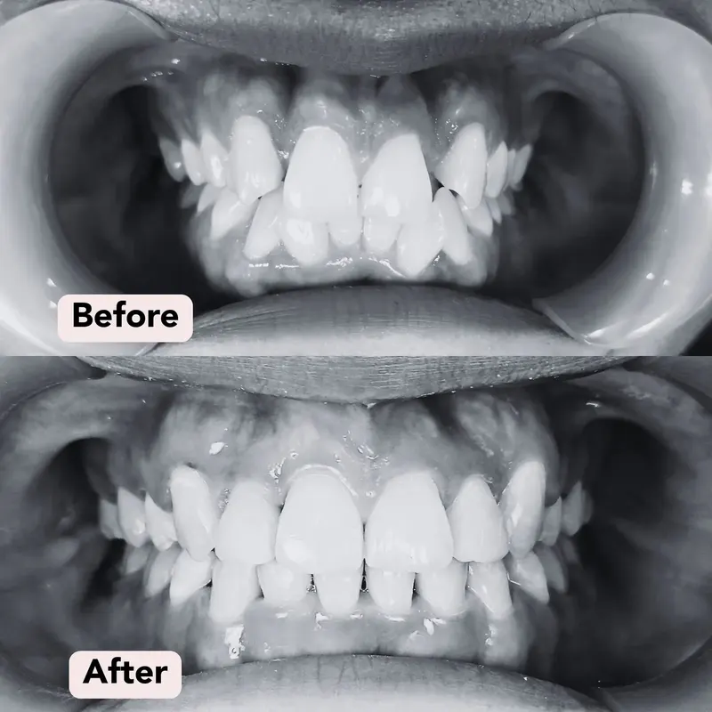 Bw braces dr s before after