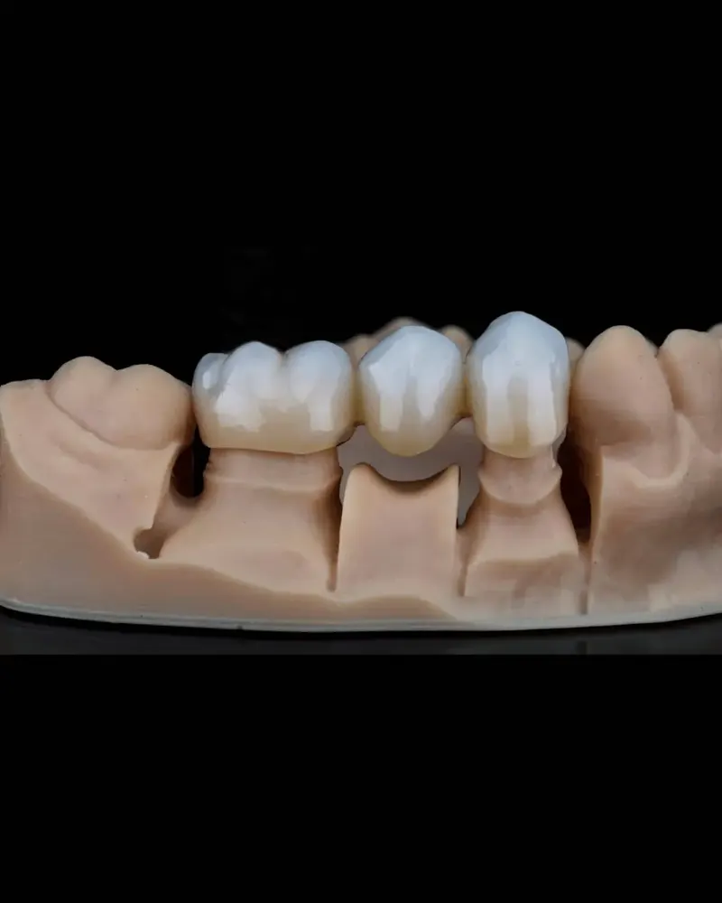 Dental bridges