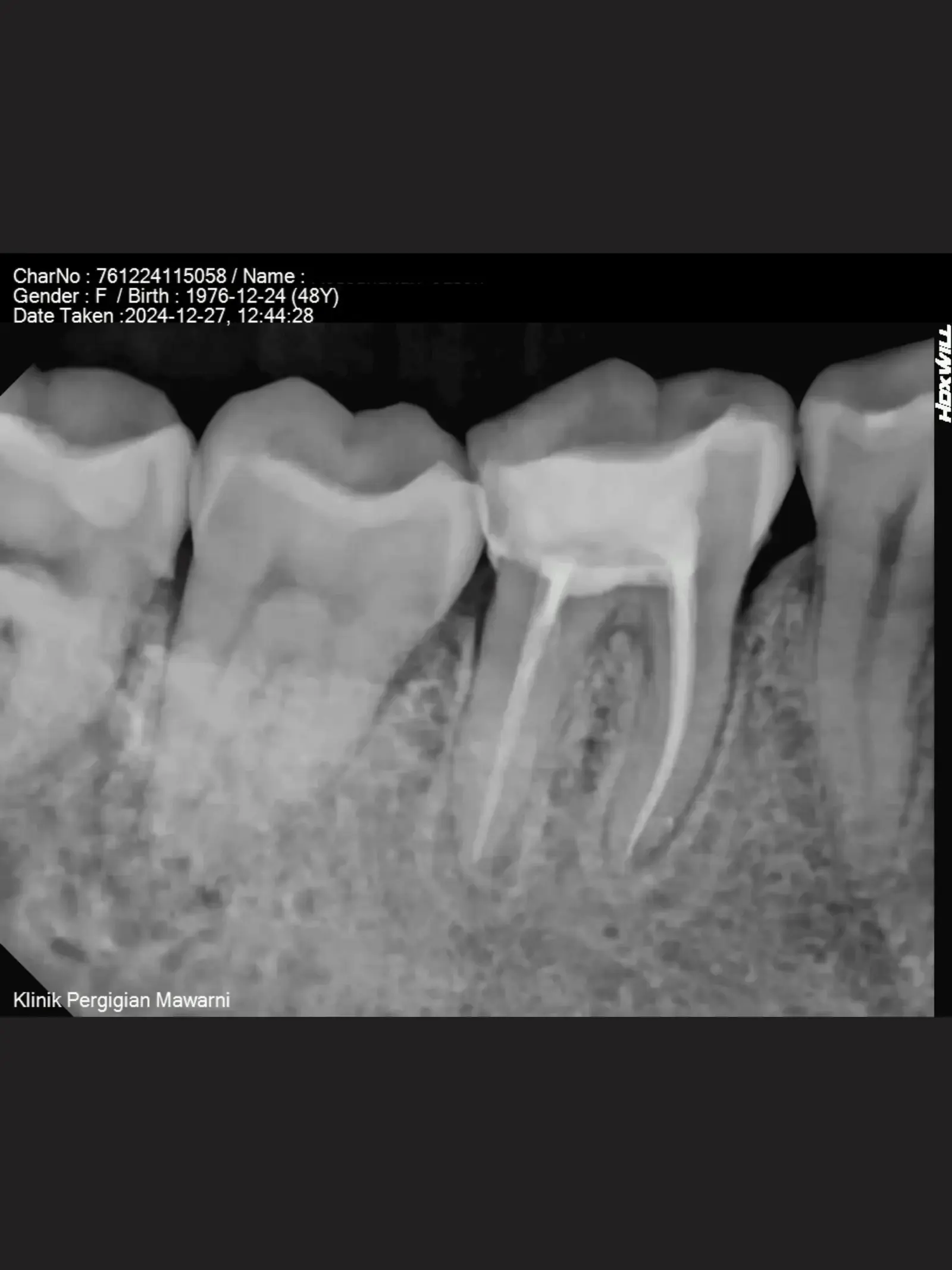 Intra oral x ray image