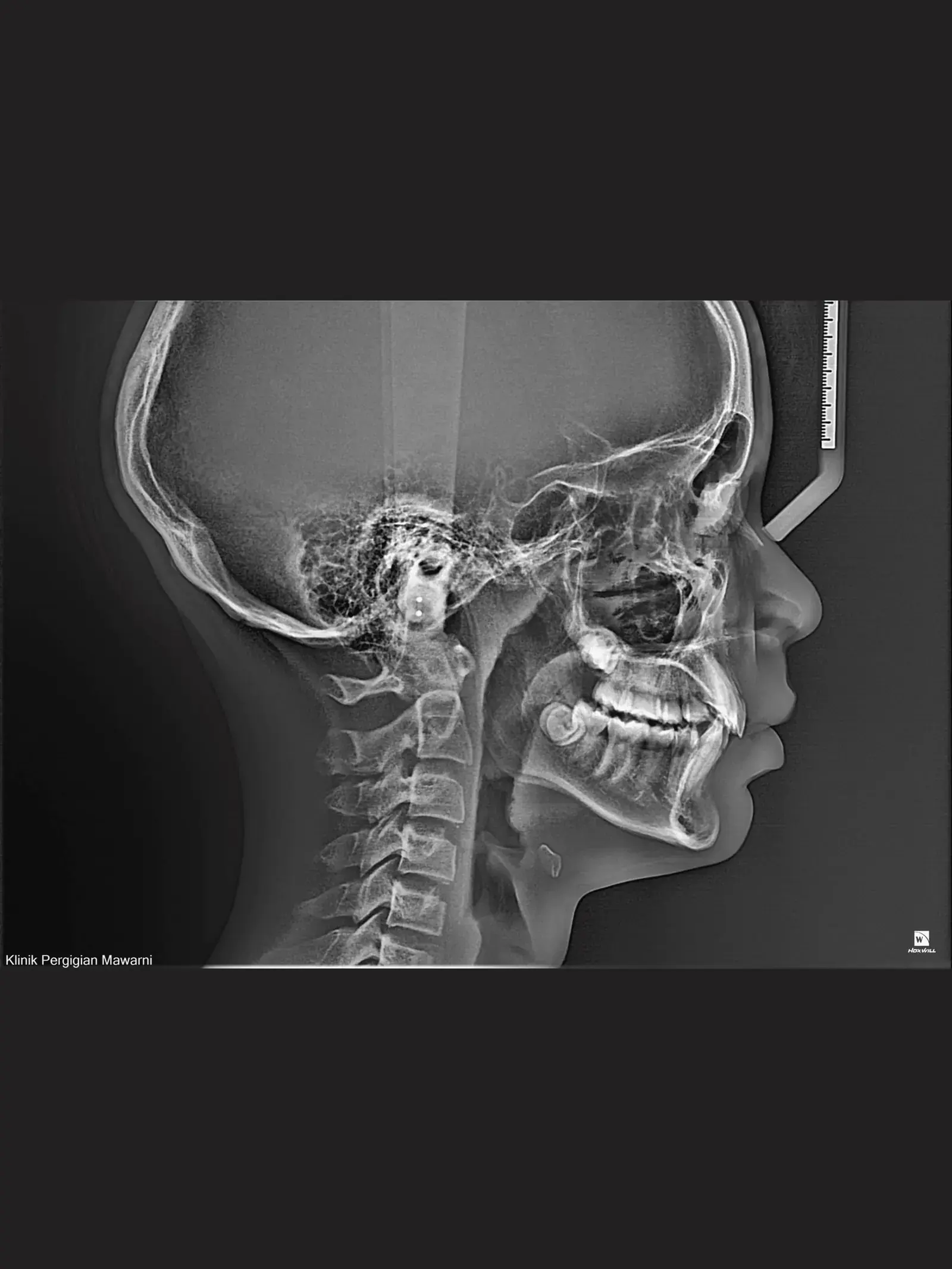 Lateral cephalometric image