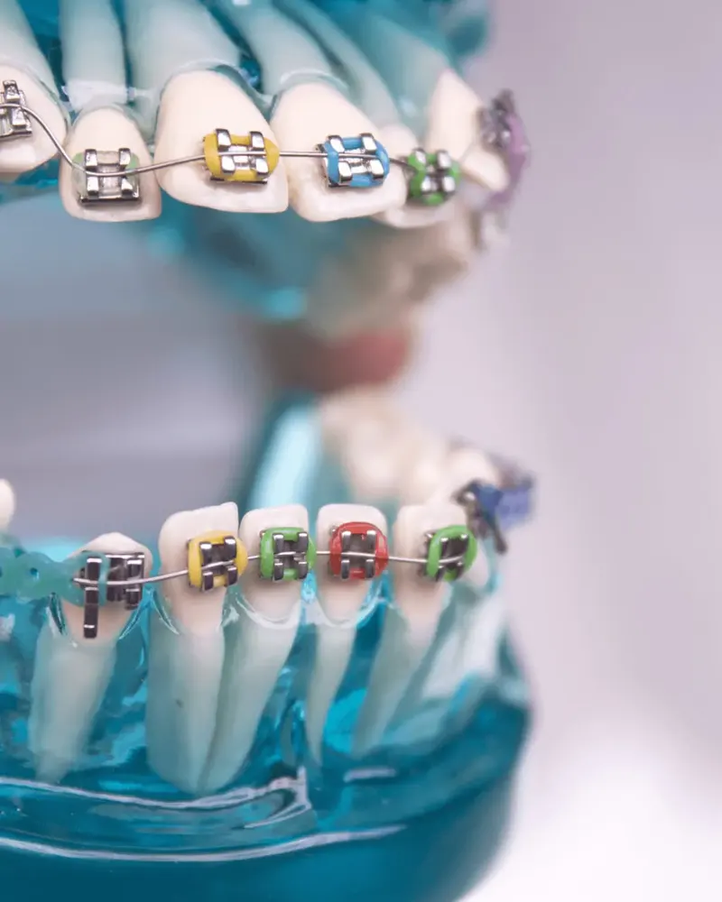 Orthodontics braces