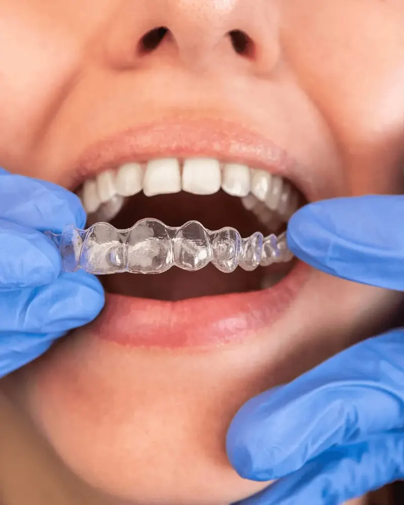 Orthodontics clear aligner