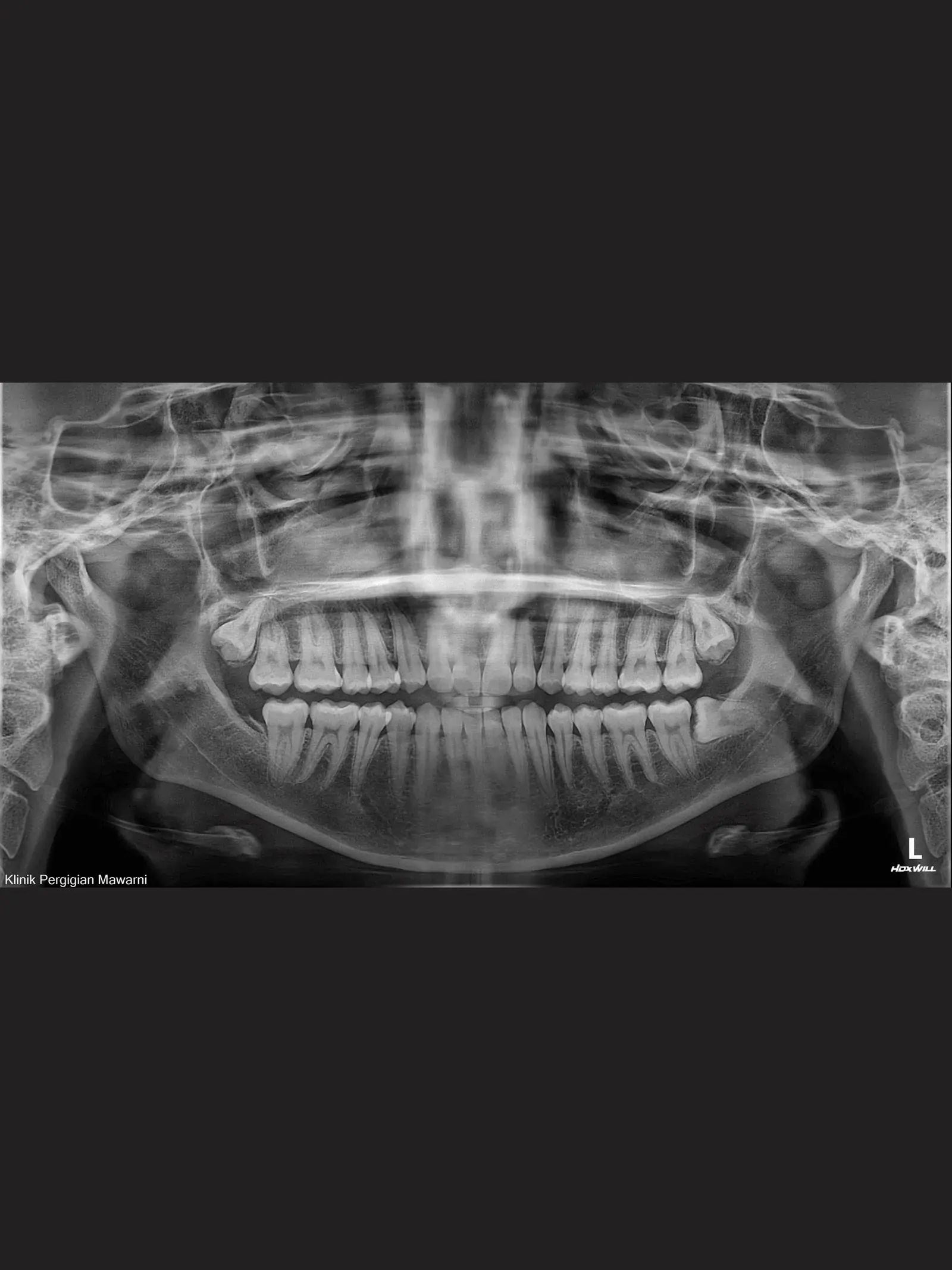 Panoramic radiograph