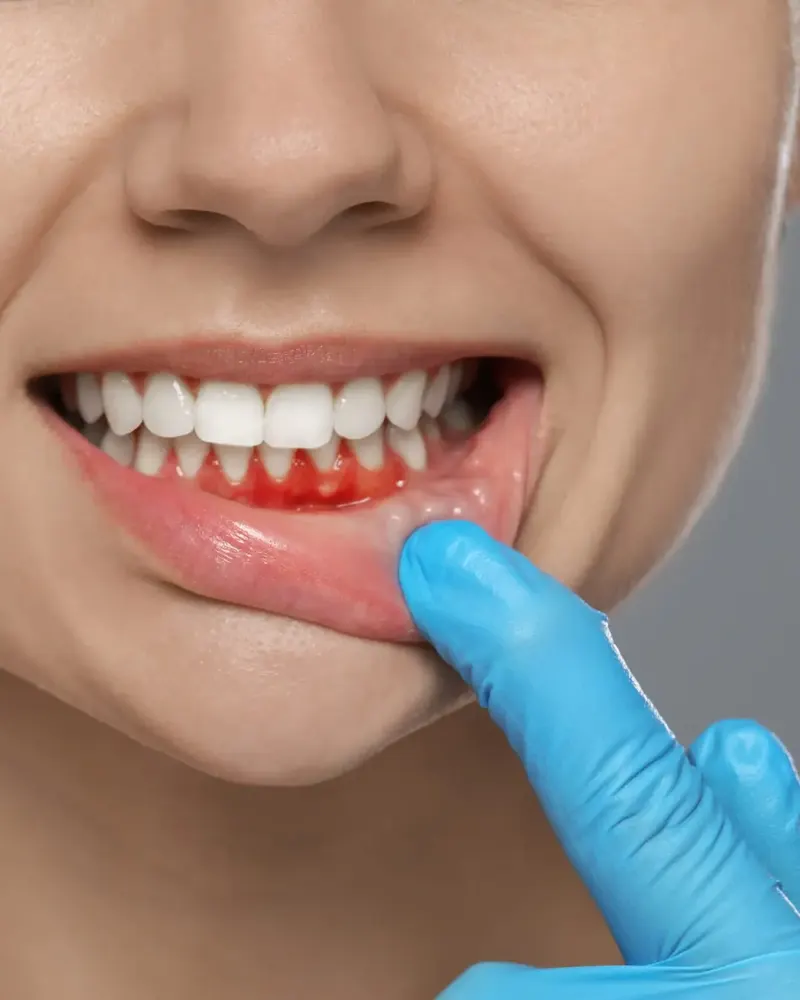 Photo gum treatment
