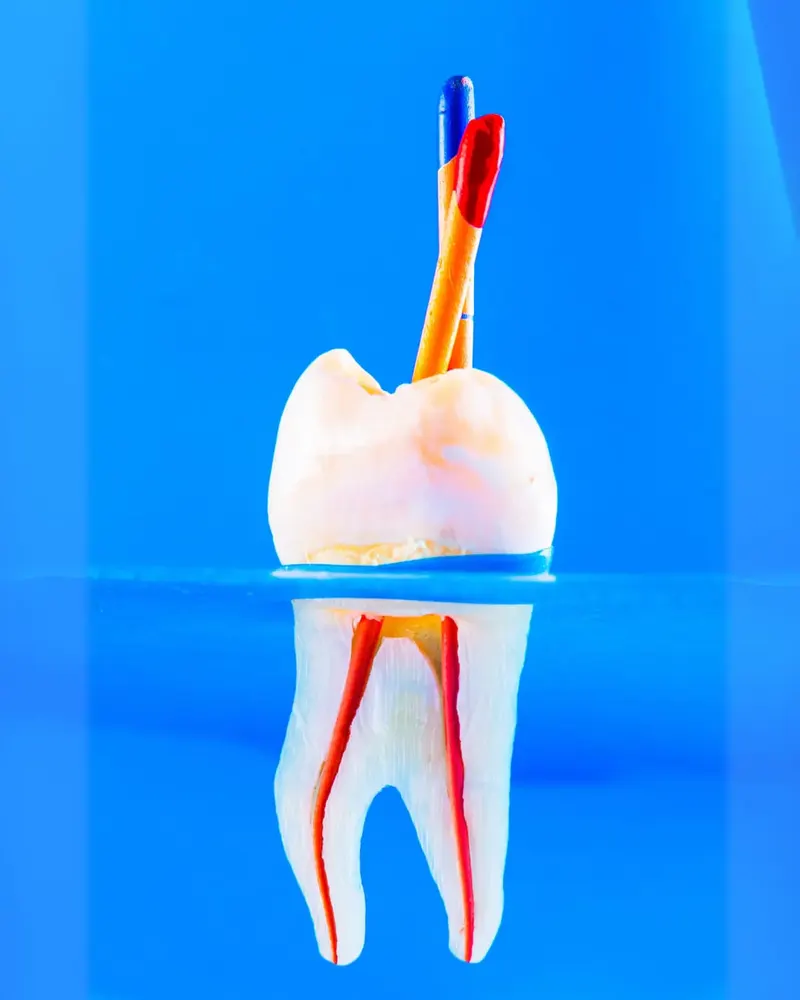 Photo root canal