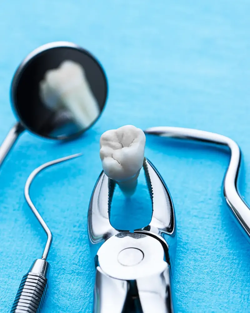Photo tooth extraction