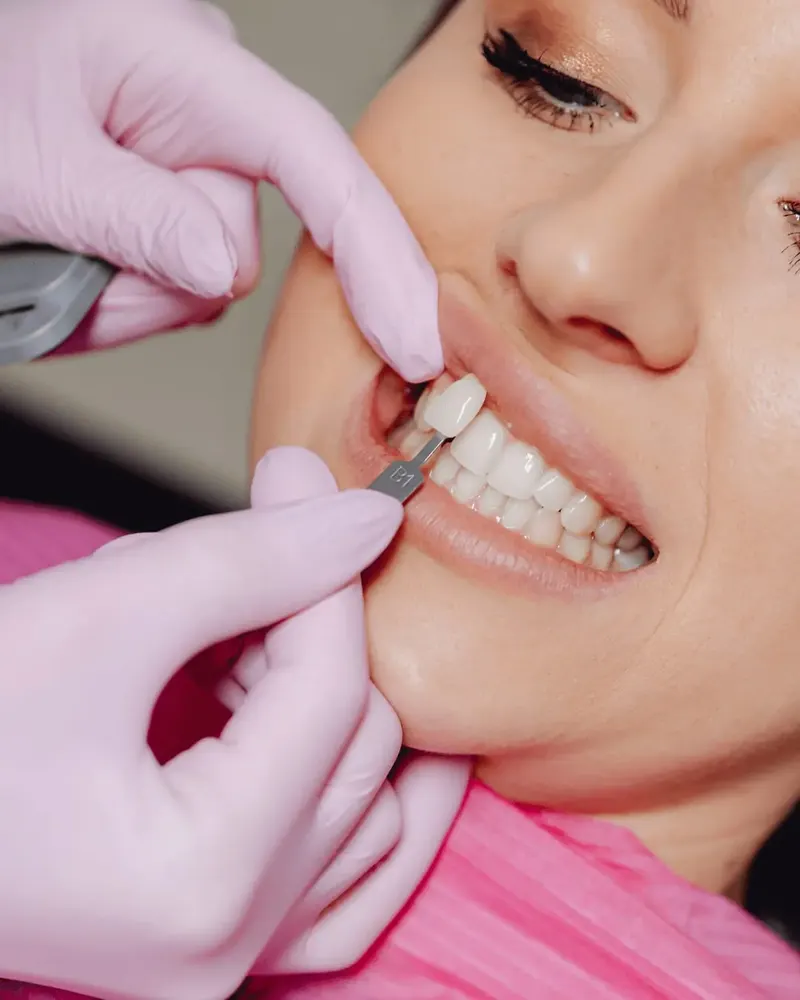Veneers snile makeover